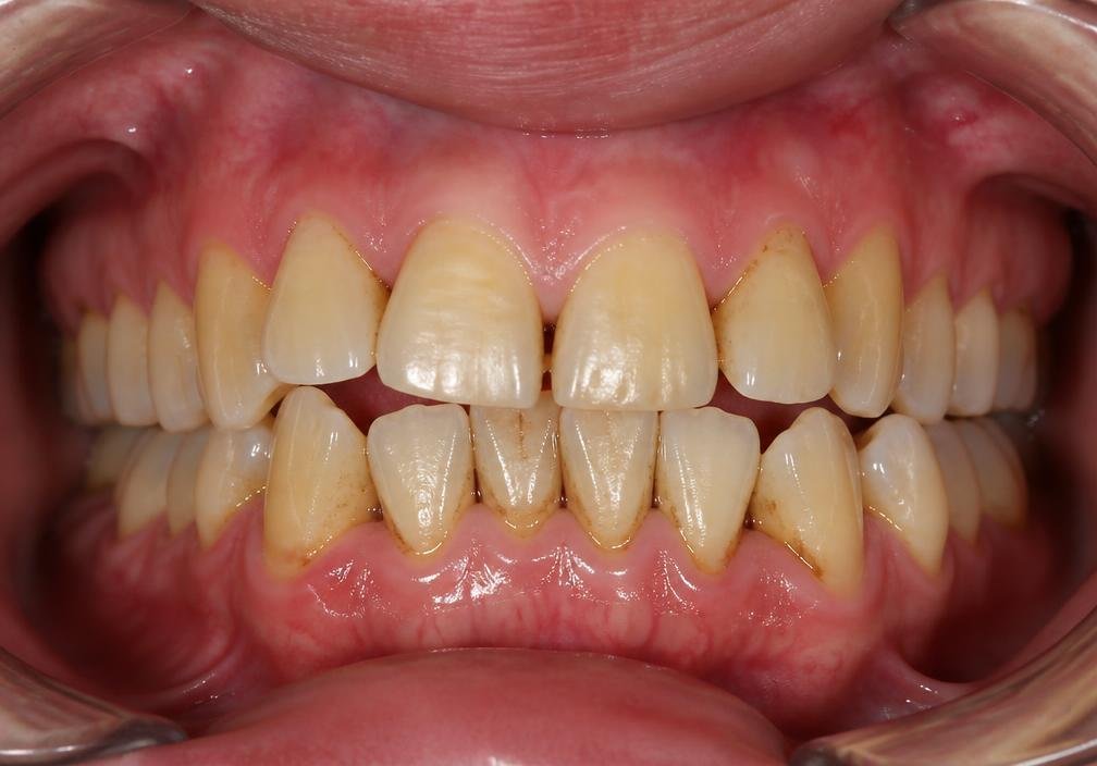 Veneers & whitening makeover — before treatment at Hema Dental